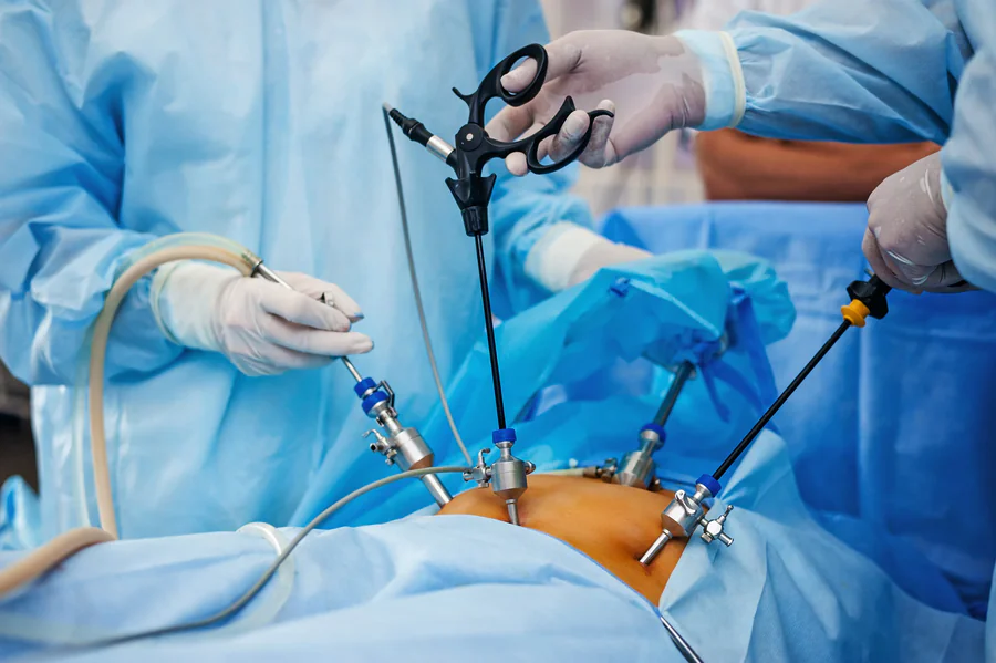 Intervention par cœlioscopie, instruments mini-invasifs insérés dans l'abdomen